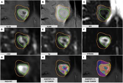 Decoding the Heterogeneity of Malignant Gliomas by PET and MRI for Spatial Habitat Analysis of Hypoxia, Perfusion, and Diffusion Imaging: A Preliminary Study